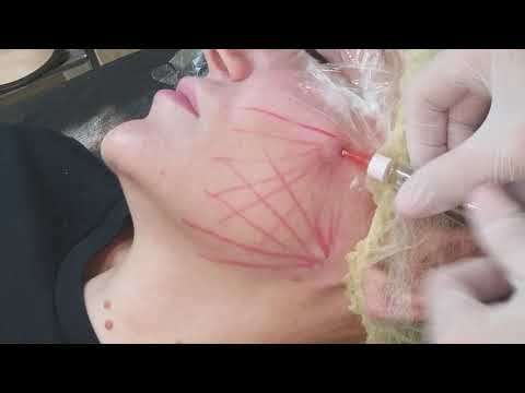 Видео: НУКЛЕОТИДЫ +БИОРЕВИТАЛИЗАНТ(канюля+игла)