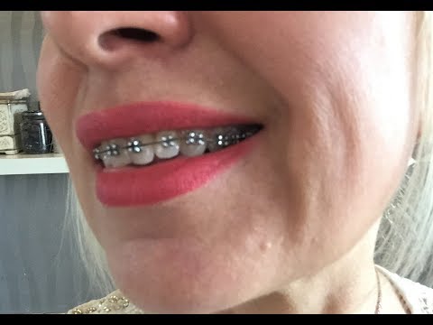 Видео: Брекеты после 40 лет. Часть 1. Миопатическая шина (капа). Удаление зубов мудрости.