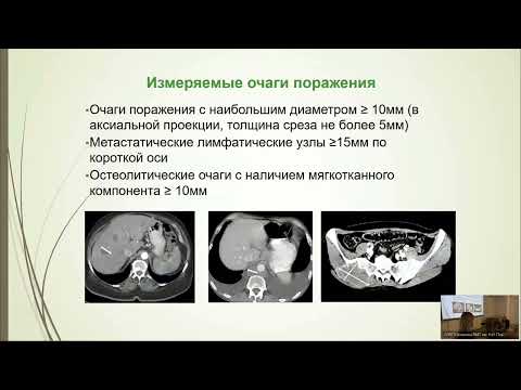 Видео: Лечение радиойодрефрактерного папиллярного рака щитовидной железы:стандарты и актуальные направления