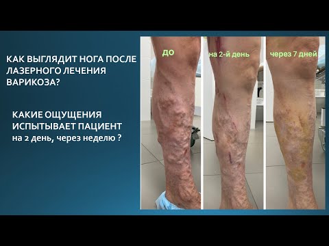 Видео: Результаты #лечения #варикоза. Что пациенту ожидать после #ЭВЛК