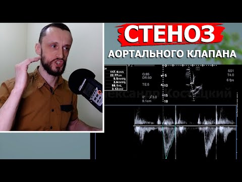 Видео: Определение степени стеноза аортального клапана | Расчет площади
