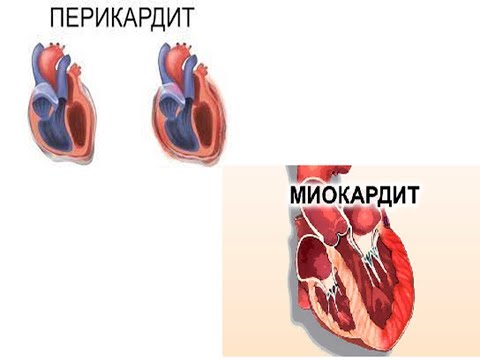 Видео: Миокардит и перикардит – что это такое?