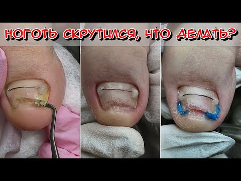 Видео: СКРУТИЛСЯ НОГОТЬ ЧТО ДЕЛАТЬ? ВРОСШИЙ НОГОТЬ / ТИТАНОВАЯ НИТЬ / ЧАСТЬ 2/ СКРУЧЕННЫЙ НОГОТЬ