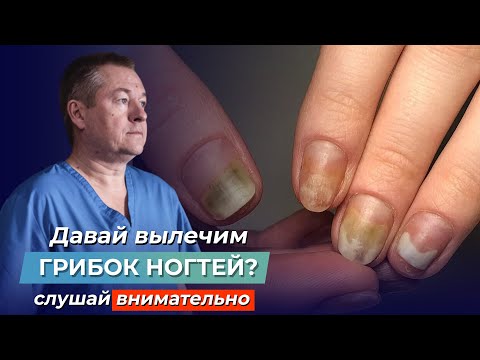 Видео: ШОКИРУЮЩАЯ ПРАВДА ПРО ГРИБОК НОГТЕЙ! Как вылечить ОНИХОМИКОЗ самостоятельно?
