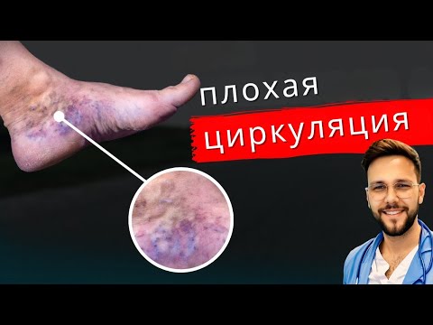 Видео: КАК МГНОВЕННО УЛУЧШИТЬ КРОВООБРАЩЕНИЕ В ОТЕЧНЫХ НОГАХ И СТОПАХ