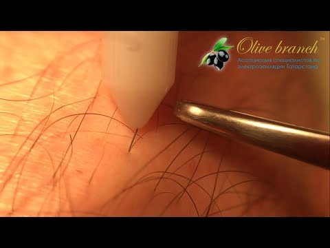 Видео: ПРОЦЕДУРА ЭЛЕКТРОЭПИЛЯЦИИ. УДАЛЕНИЕ ВОЛОС НАВСЕГДА (МАКРОСЪЁМКА)