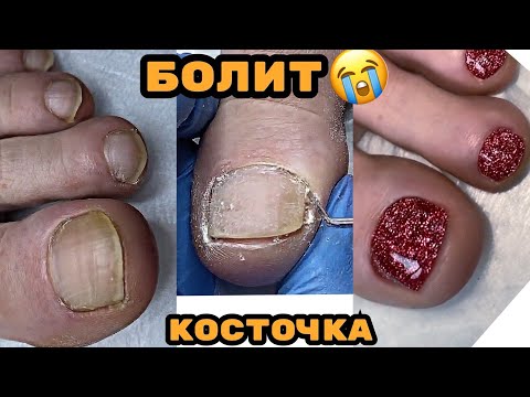 Видео: Болит косточка что делать? Педикюр на клиенте / Светоотражающий гель лак