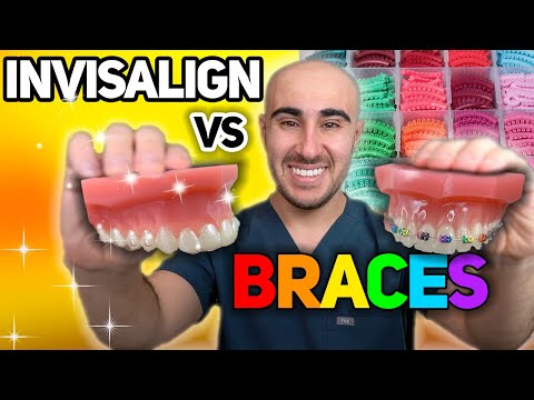 Видео: Брекеты против Invisalign: цена, зубная боль, скорость и т. д. — ПОЛНЫЙ обзор 🔥