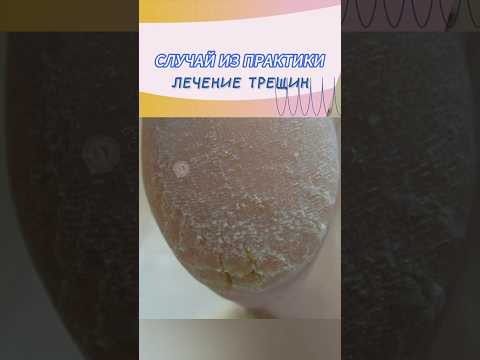 Видео: Лечение трещин #трещинынапятках #трещины #подология #подолог #стопы #стопа #педикюр