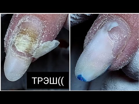 Видео: ЖУТКИЕ отслойки ((((