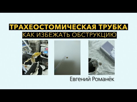 Видео: Трахеостомическая трубка. Как избежать обструкцию