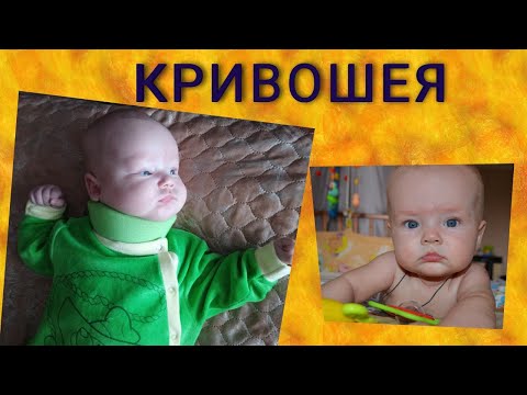 Видео: Кривошея у новорожденного. Деформация черепа.Лечение и профилактика