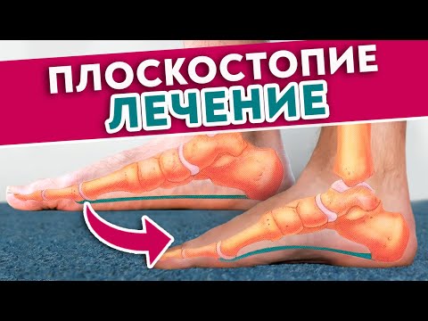 Видео: Как убрать ПЛОСКОСТОПИЕ раз и навсегда? Профессиональный массаж стоп от плоскостопия