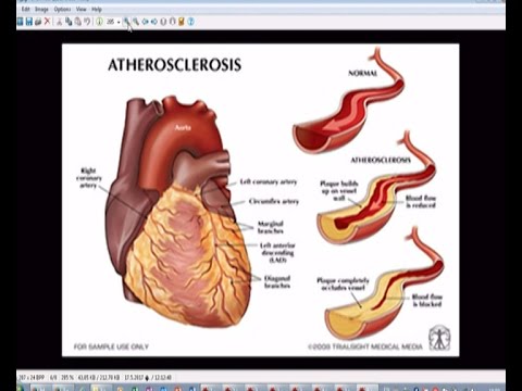 Видео: Академия ЗдравОсловно: Хипертония