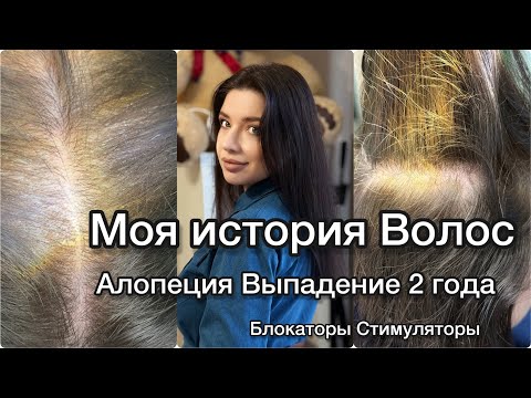 Видео: ❎ВСЕ ПРО ВЫПАДЕНИЕ ВОЛОС! Как НЕ ОБЛЫСЕТЬ? Алопеция. Диффузное выпадение волос. История моих волос.