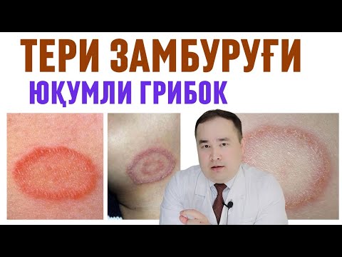 Видео: ТЕРИДА ТОШМАЛИ ЗАМБУРУҒ КАСАЛЛИГИ ВА УЙ ШАРОИТИДА ДАВОСИ ХАҚИДА / МИКОЗ ГИБОК / ИСЧАНОВ