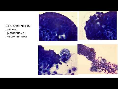 Видео: Опыт применения цитологического исследования в диагностике опухолей яичника