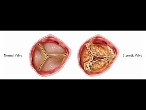 Видео: Аортальные пороки 1 часть