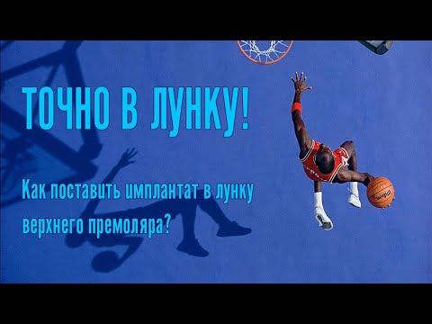 Видео: Как одномоментно установить имплантат в лунку верхнего премоляра? Подробный видео-разбор