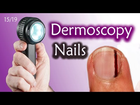 Видео: 5 простых правил, которые НИКОГДА не пропустят меланому ногтя