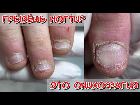 Видео: Онихофагия Что это? Как лечить? психосоматик / Грызет ногти подросток