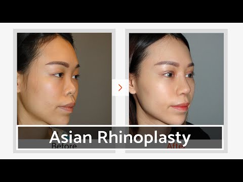 Видео: Ринопластика с реберным хрящом | Клиника VIP в Южной Корее