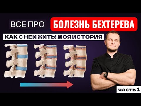 Видео: БОЛЕЗНЬ БЕХТЕРЕВА КАК С НЕЙ ЖИТЬ! МОЯ ИСТОРИЯ 🕊️