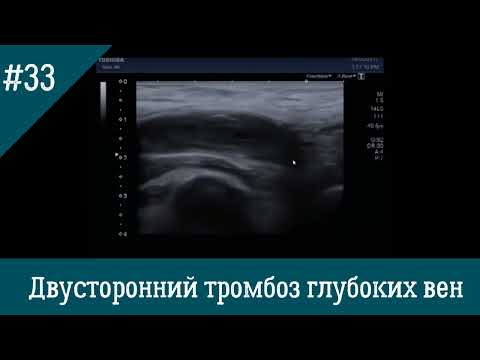 Видео: УЗИ вен. Двусторонний тромбоз глубоких вен подвздошно-бедренно-подколенно-берцового сегмента.