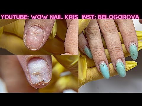 Видео: Ноготь трескался пополам -Жуткое зрелище😱| Изувечила покрытие на кухне| Что делать с травмами ?