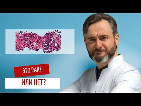 Видео: Как не пропустить рак простаты на 1 стадии: советы врача