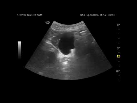 Видео: Ультразвуковая диагностика (УЗИ). Доктор Иогансен. Видеопримеры. Выпуск 31. Кисты печени.