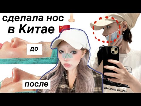 Видео: СДЕЛАЛА НОС В КИТАЕ 🇨🇳 | мой опыт | как найти клинику