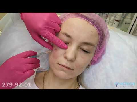 Видео: Коррекция носослезной борозды филлером Yvoire Classic (Ивор Классик)
