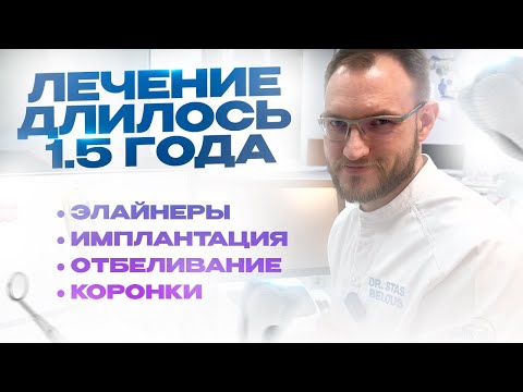 Видео: Лечили 1.5 года и не вылечили... Удалили 8 зубы, сделали импланты, коронки, элайнеры, отбеливание)