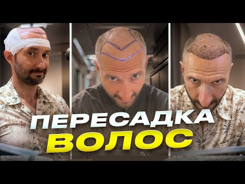 Видео: Пересадка волос и инвестиции / Боль, гарантии, что самое тяжелое