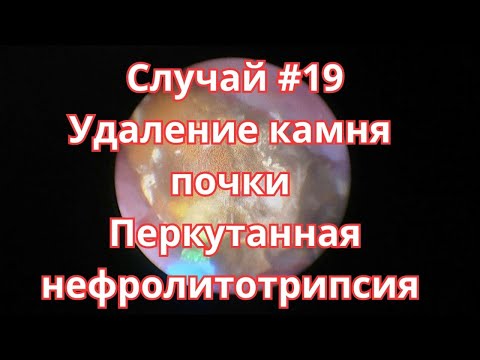 Видео: Случай #19. Удаление камня почки. Перкутанная нефролитотрипсия.