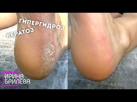 Видео: Кератоз + Гипергидроз 🌸 ПЕДИКЮР колпачками 🌸 Ирина Брилёва