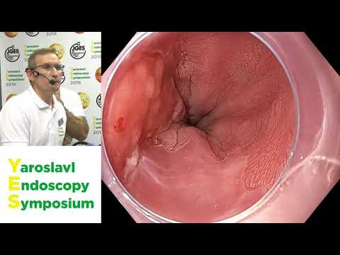 Видео: Диагностика пищевода Баррета. С. Кашин и Чезаро Хасан