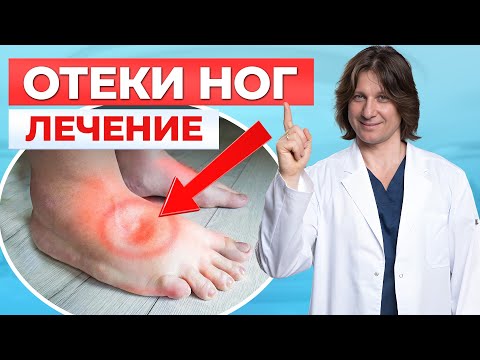 Видео: Что делать, если отекают ноги? 5 причин и способы лечения отека ног