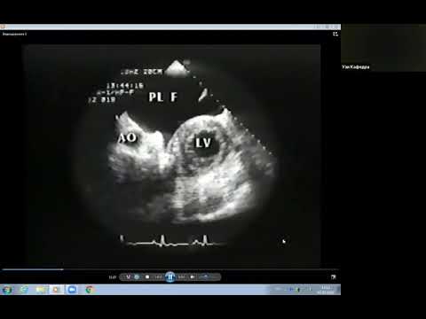 Видео: Видеолекция клиники Мэйо  Перекардиты