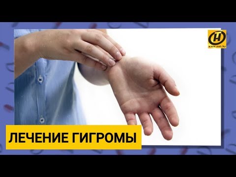 Видео: Шишка на запястье: лечение гигромы. Формула здоровья