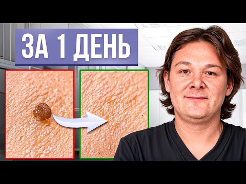 Видео: Избавься НАВСЕГДА от папиллом и бородавок! Один простой способ...