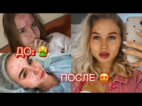 Видео: ВЫЛЕЧИЛА ПРЫЩИ  // мой путь к идеальной коже