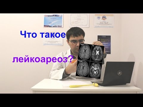 Видео: Лейкоареоз головного мозга: что это такое?