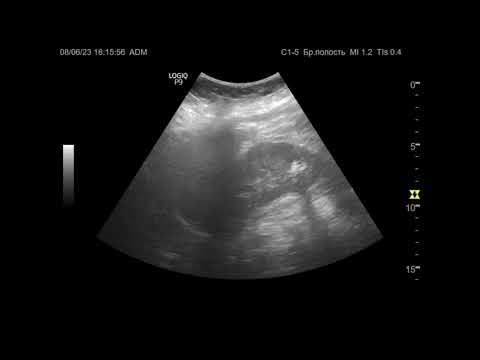 Видео: Ультразвуковая диагностика (УЗИ). Доктор Иогансен. Видеопримеры. Выпуск 42. Камни почек.