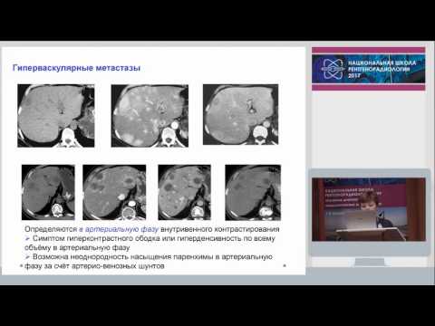 Видео: Г.А. Сташук - Метастазы в печень