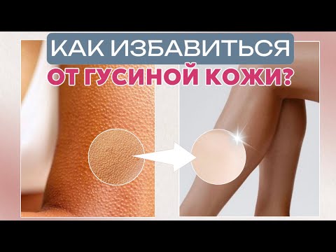 Видео: Как победить "гусиную кожу" | Фолликулярный кератоз