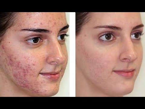 Видео: "Новое об акне (Акне: Апдейт)" - проф. Аравийская Е.А.