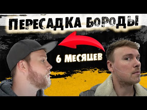 Видео: Пересадка бороды неудачный пример. Как не стоит делать пересадку бороды. Андрей борода Выпуск №22
