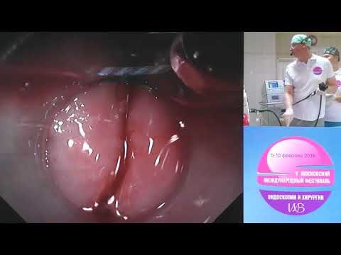 Видео: 27 Live Шишин КВ POEM при ахалазии пищевода ERBE Aohua AQ100